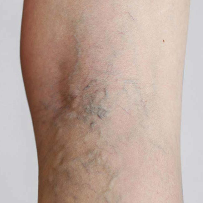 En kvinde viser sine åreknuder på benet.