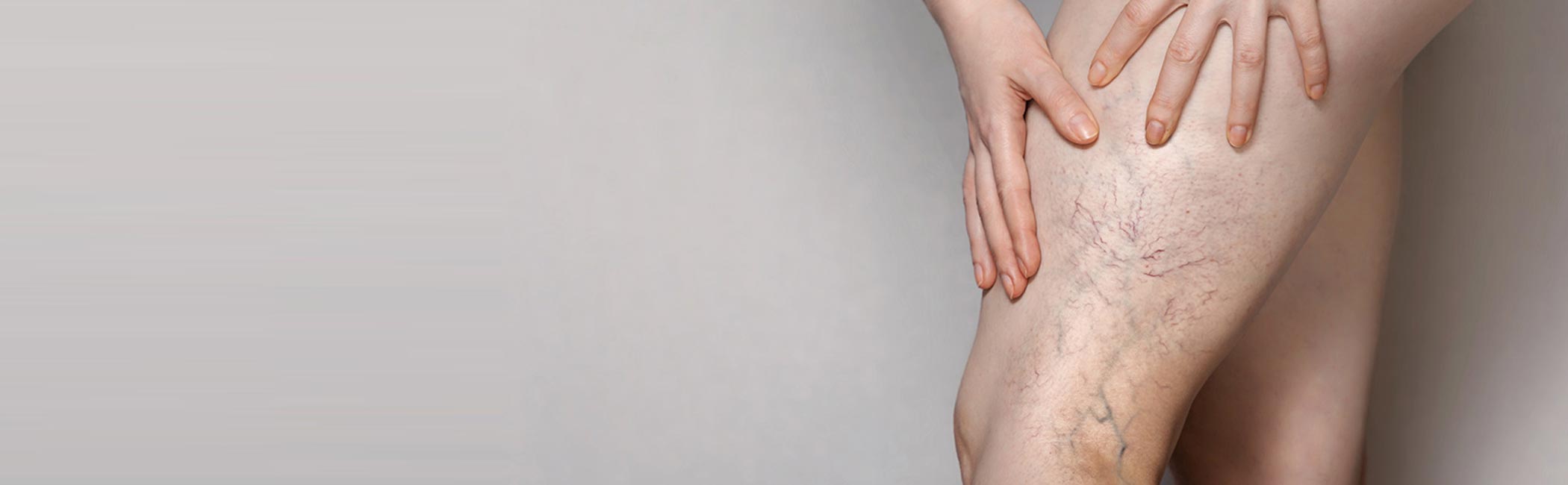 En kvinde viser sine åreknuder på benet.