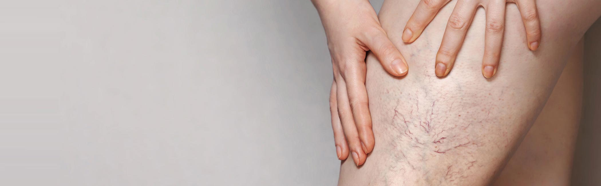 En kvinde viser sine åreknuder på benet.