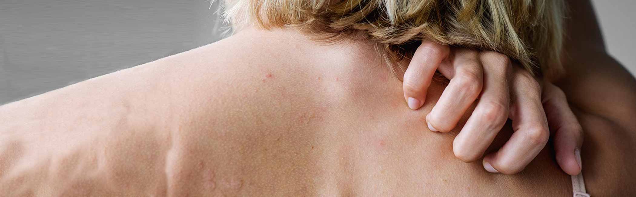 Kvinde med allergi udbrud klør sig på ryggen.