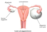 Cyster på æggestokkene.