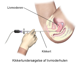 Kikkertundersøgelse af livmoderhulen.