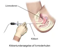 Kikkertundersøgelse af livmoderhulen.