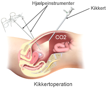 Hjælpeinstrumenter ved en kikkertoperation.