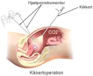 Hjælpeinstrumenter ved en kikkertoperation.