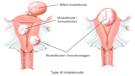 Forskellige typer af muskelknuder.
