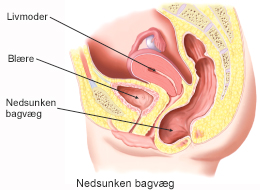 Nedsunken bagvæg.