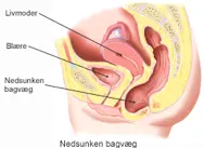 Nedsunken bagvæg.