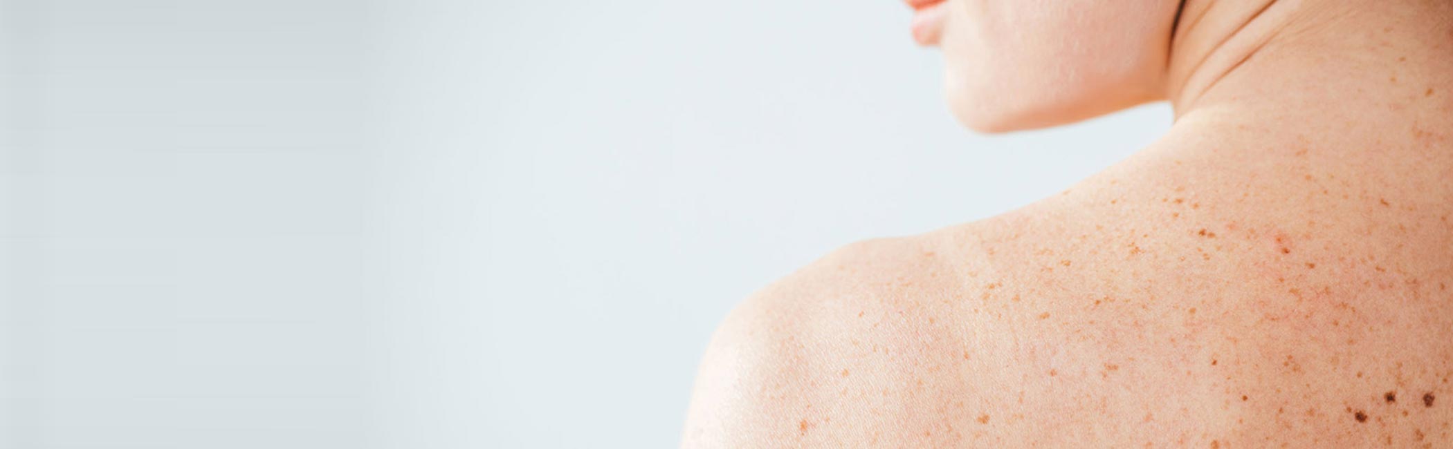 En kvinde, som skal til at få taget en allergitest.