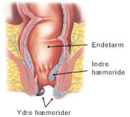 Ydre og inde hæmoride ved endetarmen.