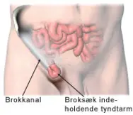 Brokkanal og broksæd indeholdende tyndtarm.