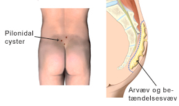 Pilonidal cyster.