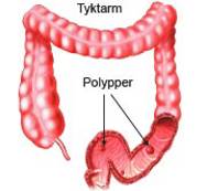 Polypper i tyktarmen.