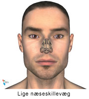 Illustration af en skæv næseskillevæg.