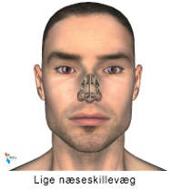 Skæv næseskillevæg.