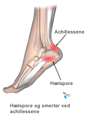 Hælspore og smerter ved achillessene.