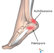 Hælspore og smerter ved achillessene.