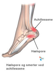 Hælspore og smerter ved achillessene.