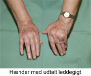 Hænder med udtalt leddegigt.