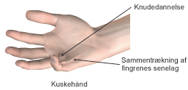 Kuskehånd med sammentrækning af fingrenes senelag.