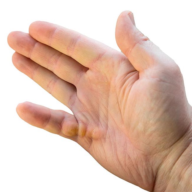 Billede af hånd med en kuskefinger.