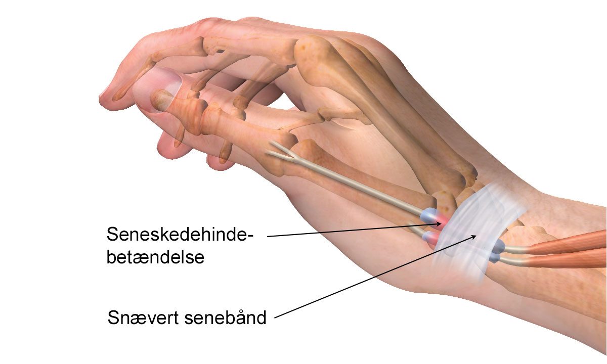 En hånd med seneskedehindebetændelse og snævert senebånd.