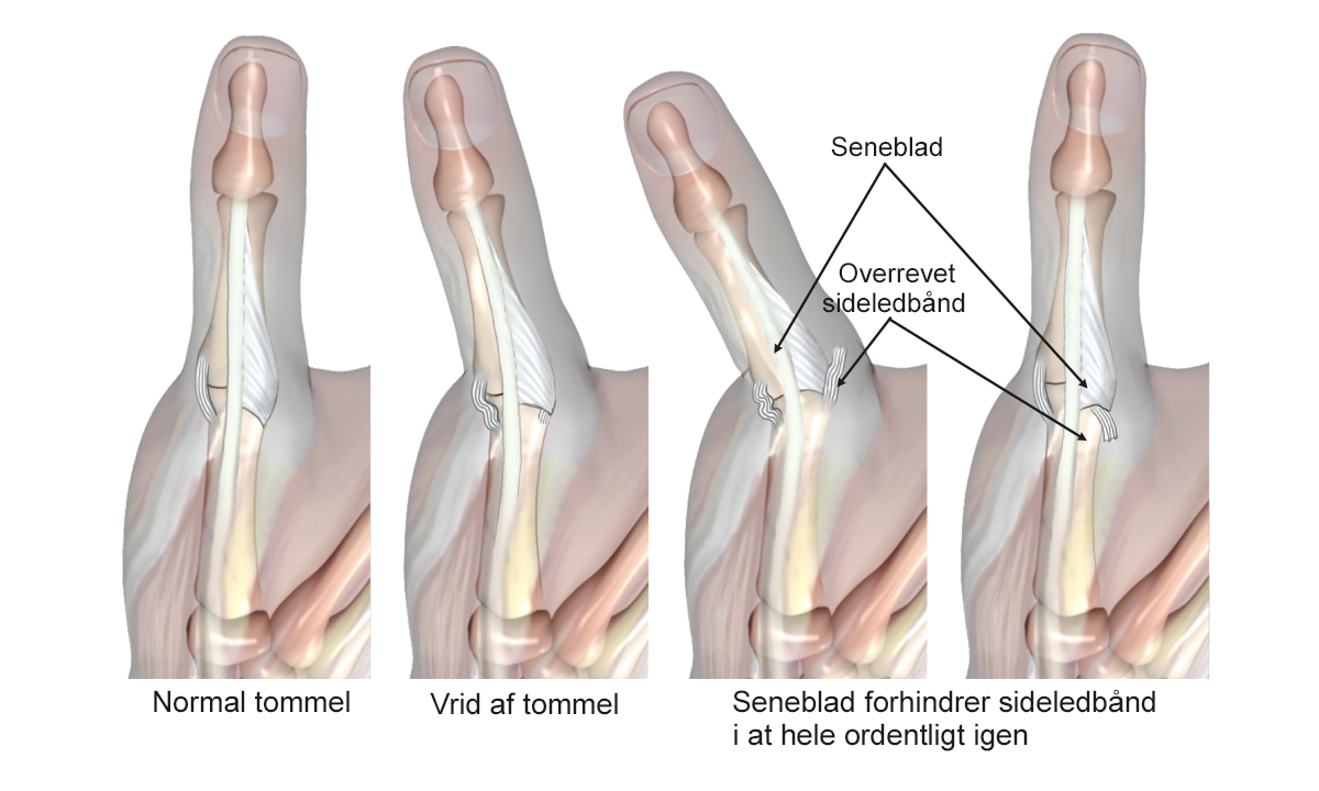Illustration af en normal tommelfinger og en skadet tommelfinger.