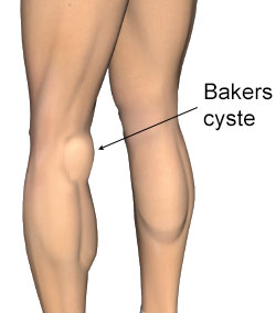 Bakers cyste i knæhulen.