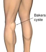Bakers cyste i knæhulen.