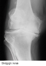 Røntgen af slidgigt i knæet.