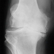 Røntgen af slidgigt i knæet.