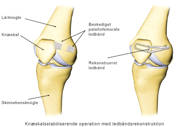 Knæskalsstabiliserende operation med ledbåndsrekonstruktion.