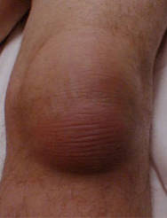 Slimsækbetændelse.