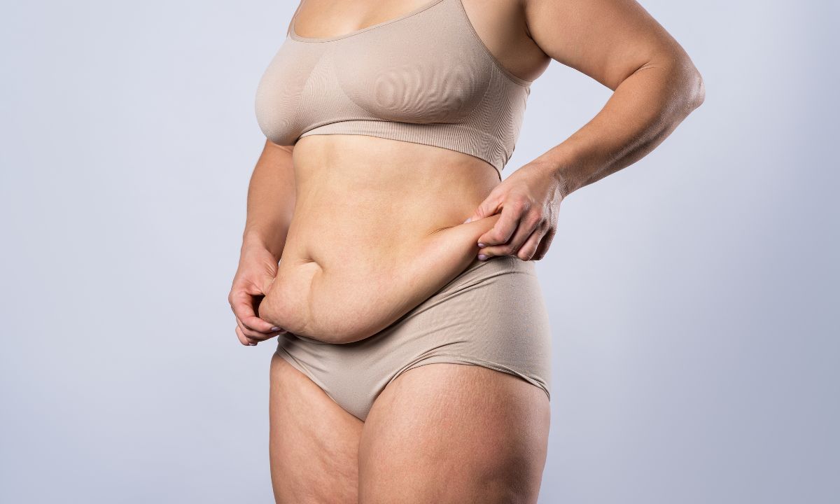 Kvinde holder ud i sin løse hud på maven efter stort vægttab.