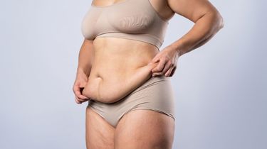Kvinde holder ud i sin løse hud på maven efter stort vægttab.