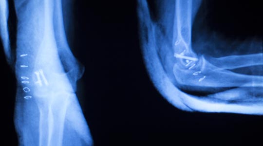 Røntgen billede af røntgenstråler.