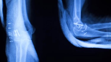 Røntgen billede af røntgenstråler.