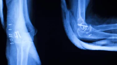 Røntgen billede af røntgenstråler.