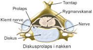 Diskusprolaps i nakken.