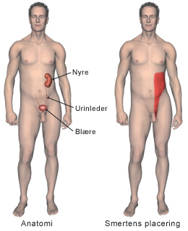 Nyresten anatomi og smertens placering.