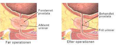 Et billede af forstørret prostata før og efter operationen.