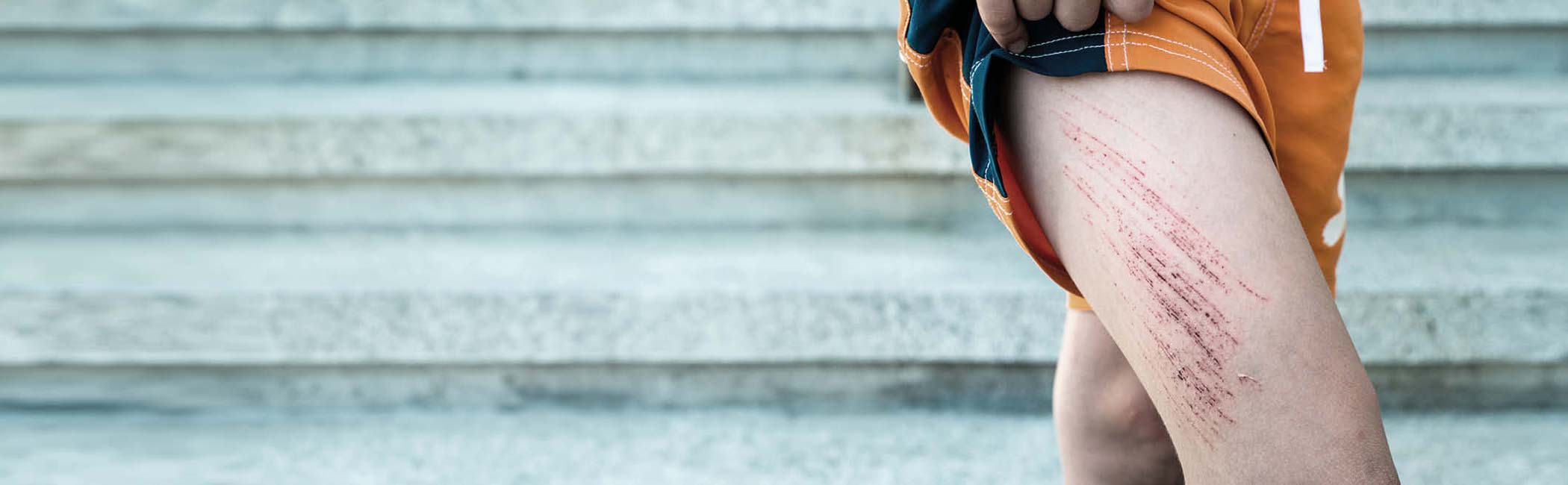 Et ben med et større sår på låret.