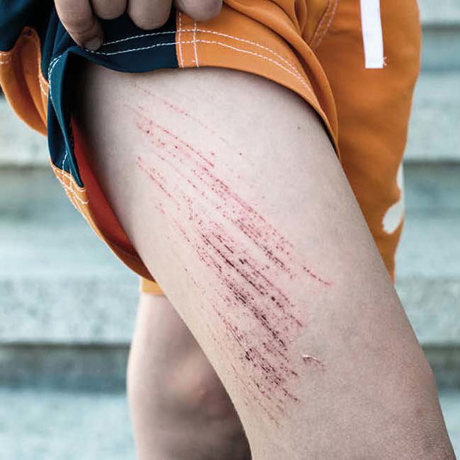 Et ben med et større sår på låret.